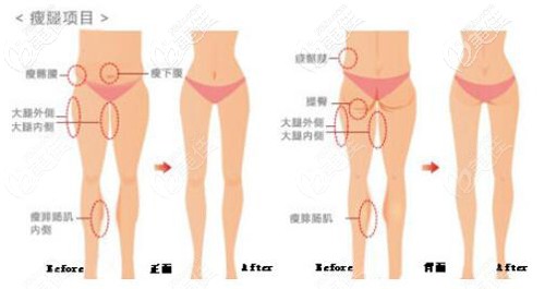 大腿吸脂的范围
