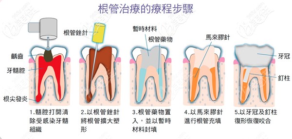根管治疗的过程步骤图 根管治疗的过程步骤图