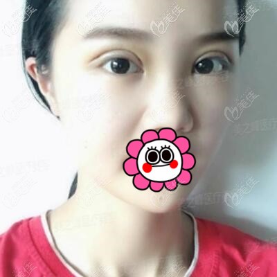 割双眼皮术后3天效果照