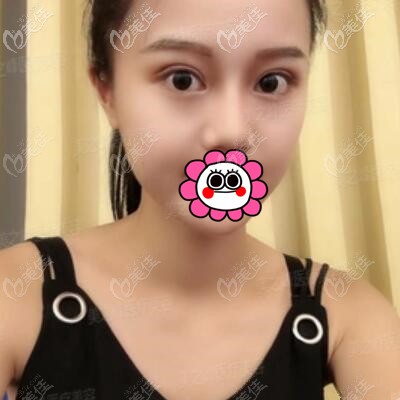 割双眼皮1个月时的恢复效果照