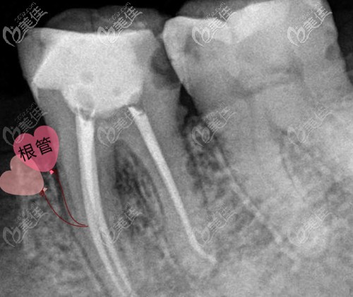 一颗牙根管再治疗的费用在1000元~1800元左右 一颗牙根管再治疗的费用在1000元~1800元左右