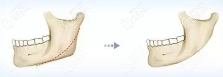 长曲线截骨手术效果 长曲线截骨手术效果