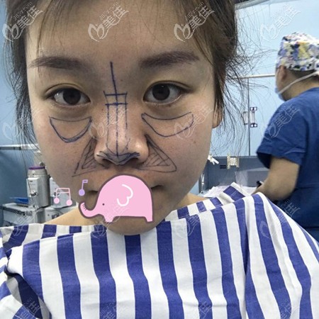 徐鹏设计的鼻综合手术方案