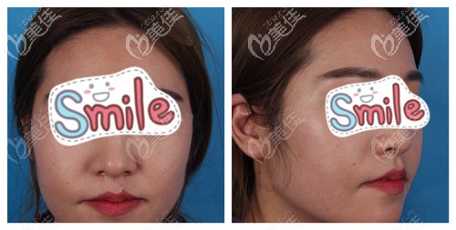 术前脸大皮肤松弛下垂 术前脸大皮肤松弛下垂