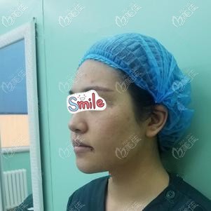 刚做完埋线提升术后脸肿胀 刚做完埋线提升术后脸肿胀