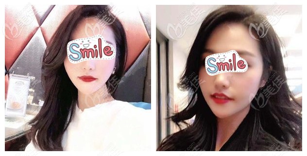 埋线提升术后15天脸部皮肤紧致 埋线提升术后15天脸部皮肤紧致