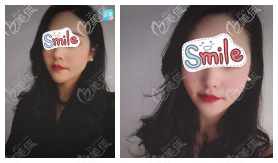 全脸埋线提升术中放了12根大V线后皮肤不仅光滑紧致就连明显的鼻唇沟也不见了