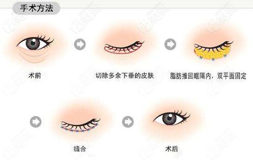 外切去眼袋的手术原理图