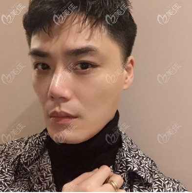 看我在广州市佳人整形医院做的假体垫眉弓效果怎么样