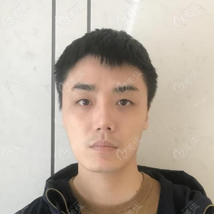 分享我做假体垫眉弓的亲身经历