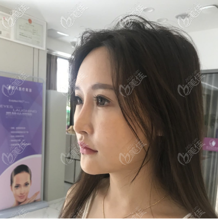 给你看看我做假体垫眉弓术前照片