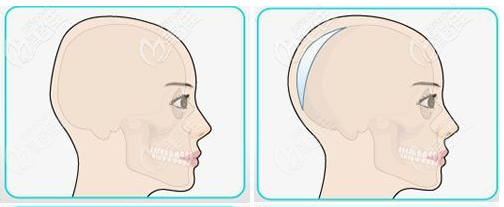 骨水泥后脑勺填充术效果演示图