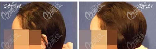 成年人扁头变圆头的成功案例