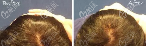 骨水泥后脑勺填充案例