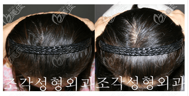 我扁头变圆头矫正成功案例