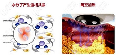 热拉提具有消脂的作用