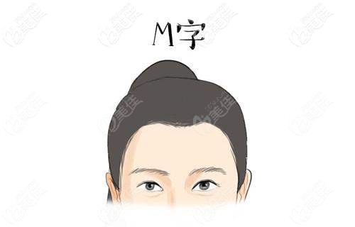 m型发际线示例图片 m型发际线示例图片