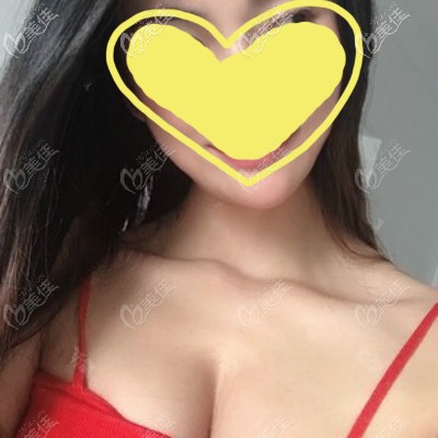 武汉亚韩医生为我做的美国曼托水滴型245cc假体隆胸,恢复三个月后手感柔软自然