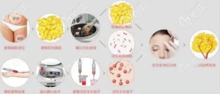 自体脂肪移植填充额头过程