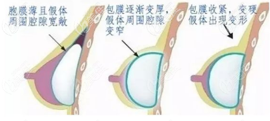 隆胸假体出现包膜挛缩 隆胸假体出现包膜挛缩