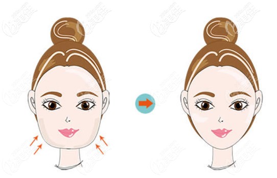 激光溶脂瘦脸效果