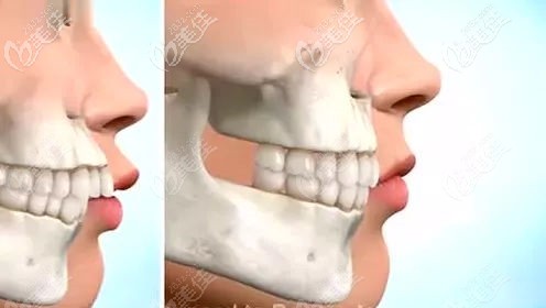 骨性龅牙除了正颌手术还能怎么治疗 骨性龅牙除了正颌手术还能怎么治疗