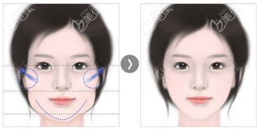 面部轮廓整形手术效果