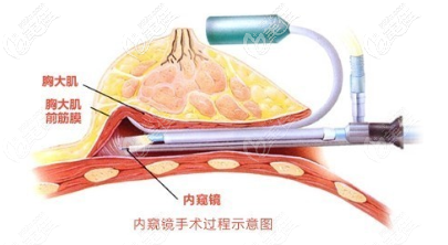 内窥镜隆胸手术过程示意图 内窥镜隆胸手术过程示意图