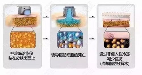 酷塑冷冻减脂的原理