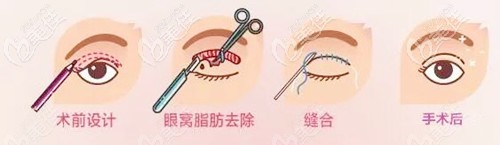 肿眼泡做全切双眼皮手术过程 肿眼泡做全切双眼皮手术过程
