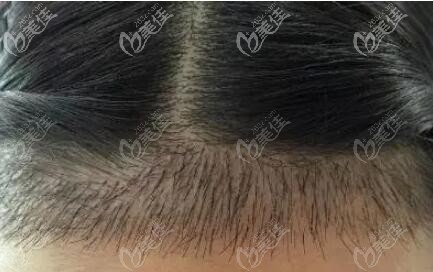 前额发际线植发效果 前额发际线植发效果