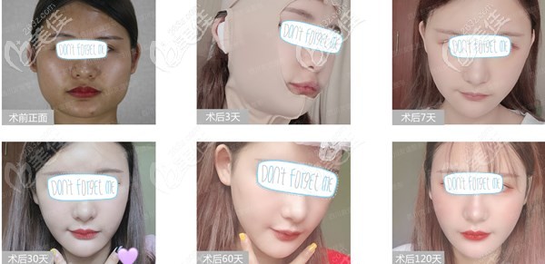 我是做了颧骨磨骨下颌角磨骨才让原来变瓜子脸的