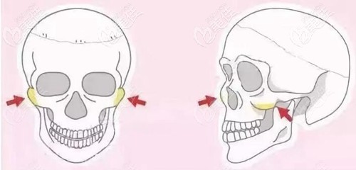 颧骨部位需要改善的情况