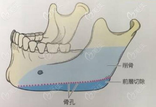 下颌骨削骨和长曲线截骨