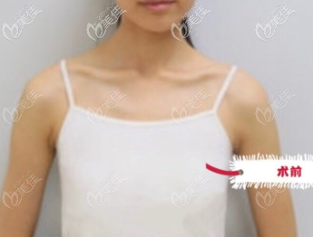 到杭州艺星做假体隆胸前 到杭州艺星做假体隆胸前