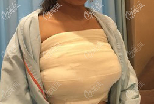 假体隆胸术后恢复三天 假体隆胸术后恢复三天