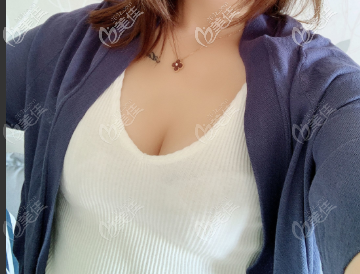 假体隆胸术后7天到医院拆线 假体隆胸术后7天到医院拆线