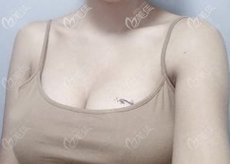 杭州艺星付德刚假体隆胸恢复一个月<span style= 杭州艺星付德刚假体隆胸恢复一个月<span style=