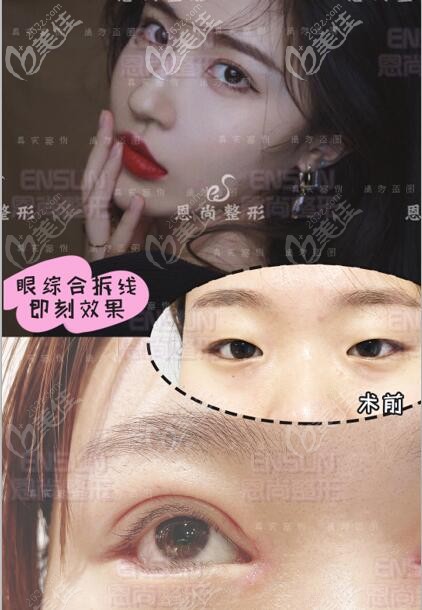 一单一内双做了7mm切开双眼皮+去皮术后即刻的效果 一单一内双做了7mm切开双眼皮+去皮术后即刻的效果