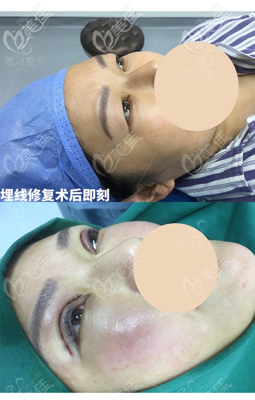 初次埋线重睑术后3个月埋线脱落,重新做了切开双眼皮+去脂的术后即刻对比照 初次埋线重睑术后3个月埋线脱落,重新做了切开双眼皮+去脂的术后即刻对比照