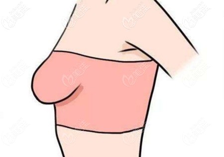乳房松弛下垂很厉害需要提胸