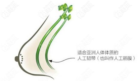 人工韧带胸部提升