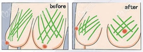 人工韧带乳房提升效果