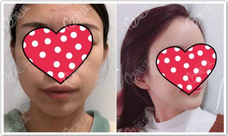 假体垫下巴2年效果图片 假体垫下巴2年效果图片