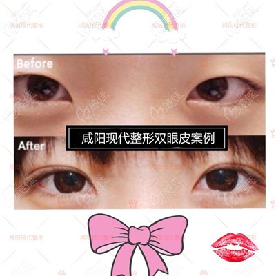 咸阳现代整形双眼皮案例 咸阳现代整形双眼皮案例