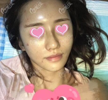 面部脂肪填充术后第2天