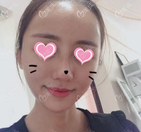 做完面部脂肪填充术后16天照