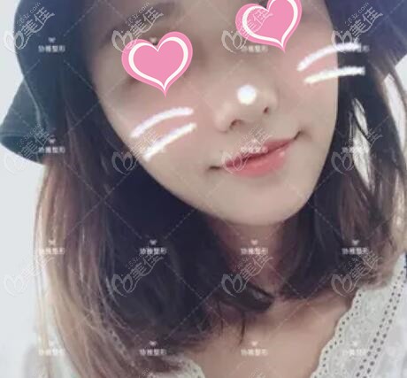 做面部脂肪填充术后1个月的恢复效果照