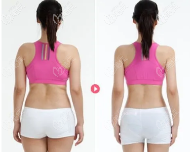 后背抽脂前后对比照片 后背抽脂前后对比照片