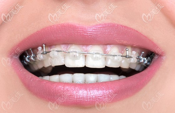 曾益平擅长青少年及成人错合畸形矫正 曾益平擅长青少年及成人错合畸形矫正